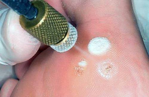 Élimination des papillomes à l'azote liquide