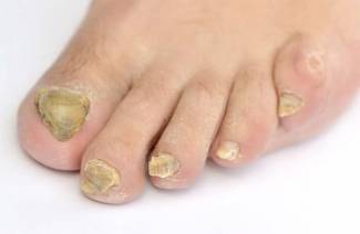Est-il possible de guérir le mycète des ongles