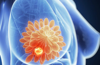 Symptômes et traitement de la mastopathie fibrokystique