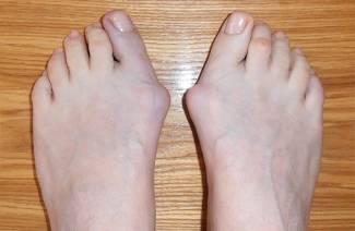 Hallux valgus