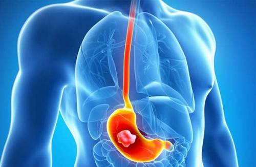 Traitement de l'érosion oesophagienne avec des médicaments