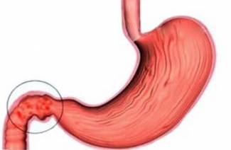Qu'est-ce qu'une bulbite d'estomac