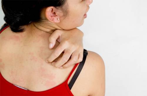 Maladies fongiques de la peau