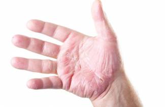 Qu'est-ce que l'eczéma?