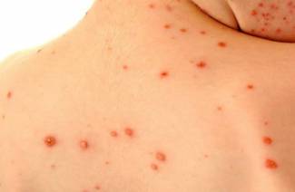 Fertőző dermatitis