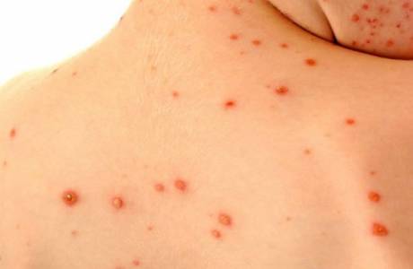 Infektiöse Dermatitis