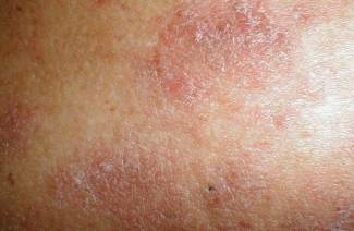 Maladies auto-immunes de la peau