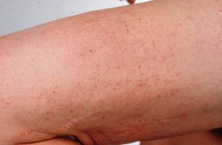 Dermatitis in der Schwangerschaft