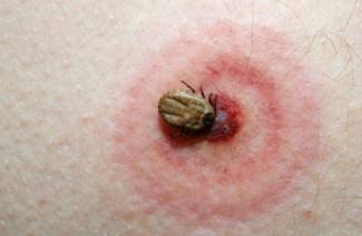 Malattia di Lyme