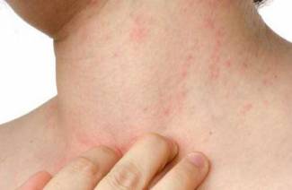 Méthotrexate pour le psoriasis