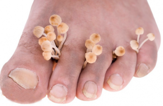 Traitement des mycoses des ongles