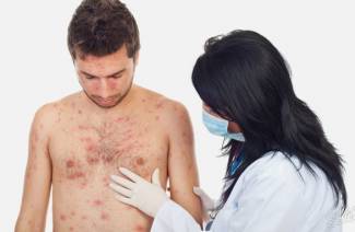 Pityriasis versicolor