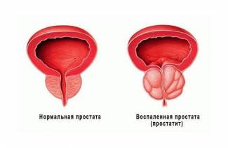 Застоен простатит