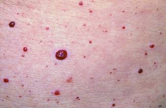 Que signifient les taupes rouges sur le corps humain?