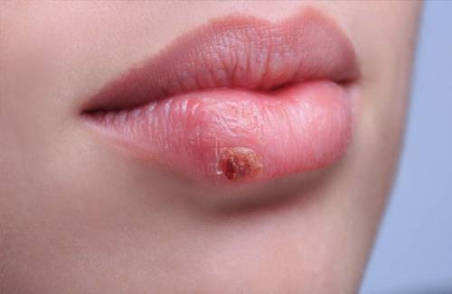 Herpes nėštumo metu