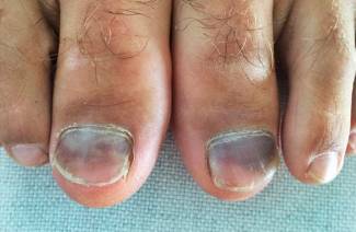 Ongles blessés