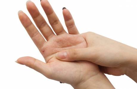 Pommade scab