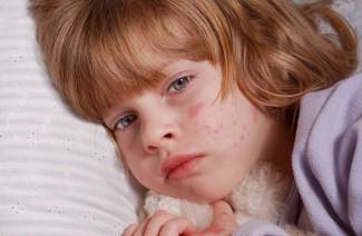 Roseola bei Kindern