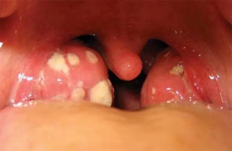 Tonsillite fungina