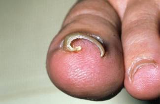 Comment enlever un ongle incarné