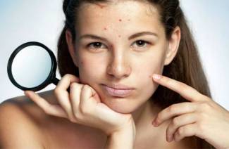 Como se livrar da acne rápida
