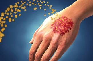 Psoriazinis artritas