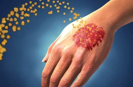 Psoriazinis artritas