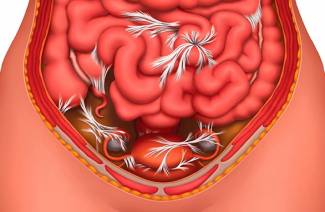 Ameliyat sonrası intestinal adezyonlar