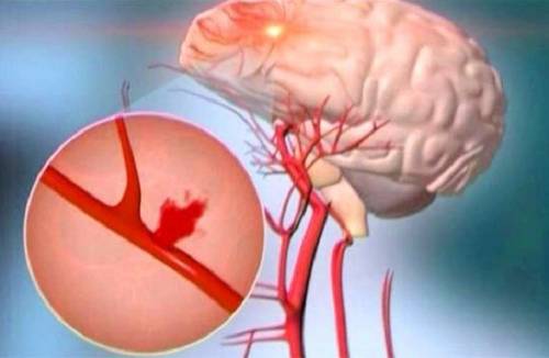 ตกเลือด subarachnoid