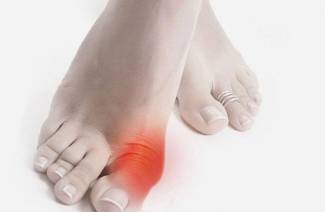 كيفية علاج النقرس على اصبع القدم الكبير