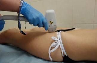 Bikini Épilation Au Laser
