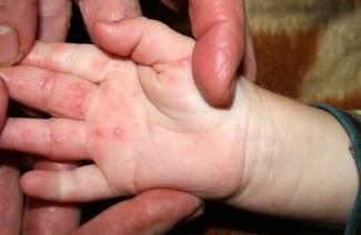 Herpes no braço