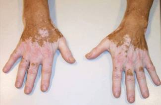 โรค Vitiligo