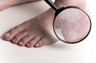 Microsporia nell'uomo