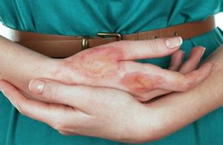 Premiers secours pour les brûlures d'huile