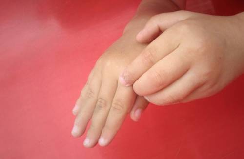 Điều trị nhuộm da tay