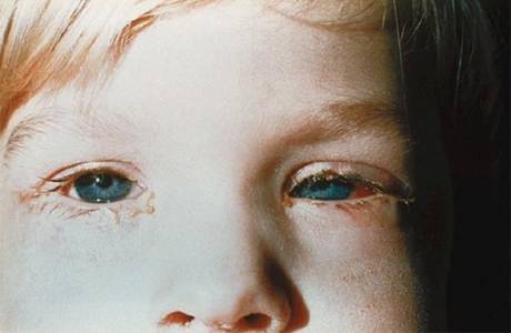 Gli occhi di un bambino si stanno inasprendo