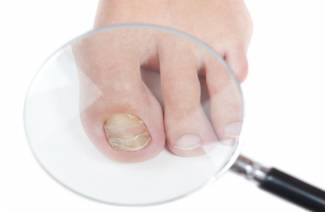 Qu'est-ce que l'onychomycose?