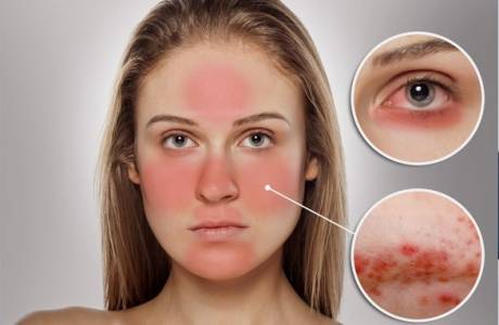Rosacea sul viso