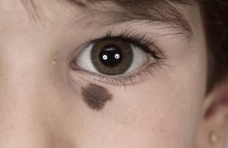 Ce qui signifie beaucoup de taupes sur le corps