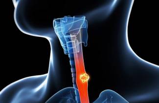 Cancer de l'oesophage