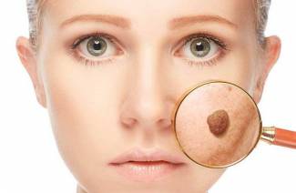 Removendo moles no rosto