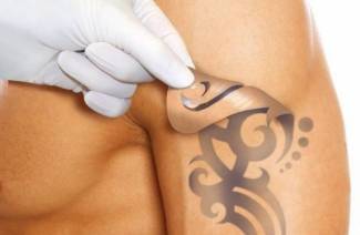 Tatuointi laserilla