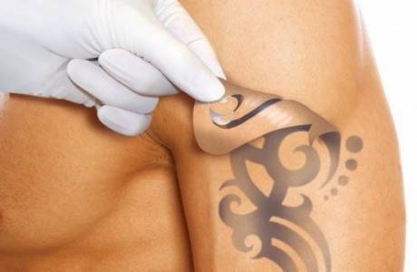 Tatuiruočių pašalinimas lazeriu