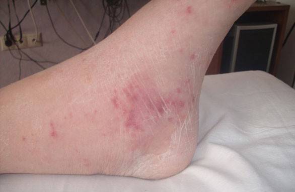 Taches sur les pieds de l'enfant
