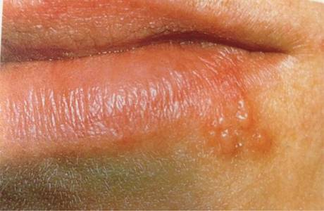 Virus dell'herpes