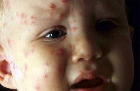Virus Coxsackie