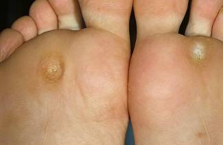 Come sbarazzarsi di calli sulle dita dei piedi