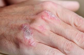 Psoriasis pustuleux