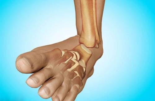 Que faire avec une luxation du pied